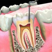 Root-canal-treatment (1)